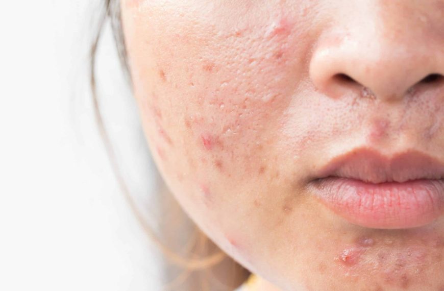 How to Reduce Acne Scars