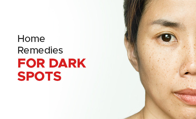 How to Treat Dark Spots: Proven Remedies & Tips